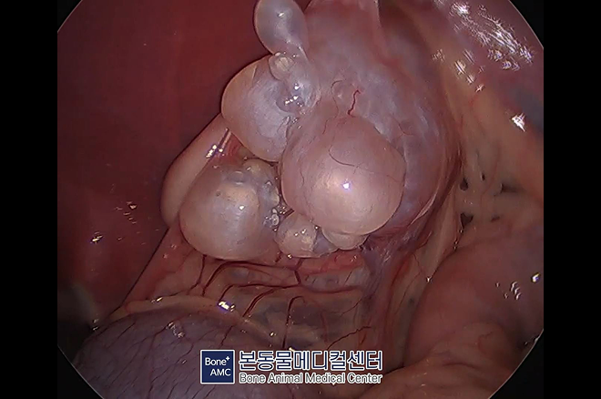 복강경 복강 종양 수술