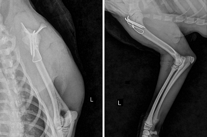 골절된 상완골 수술후 X-ray 사진