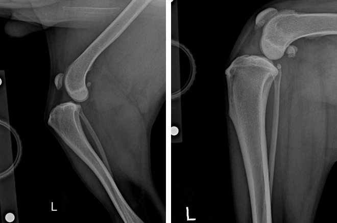십자인대 파열 수술전 X-ray 사진
