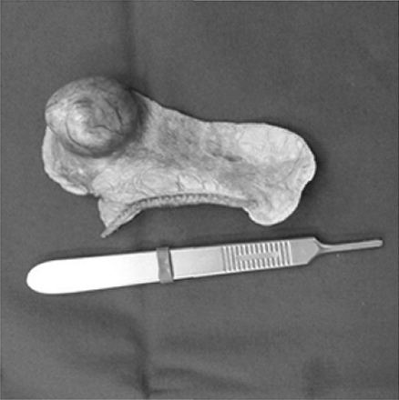 수술적으로 제거된 폐 종양